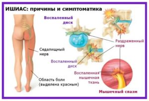 как лечить седалищный нерв