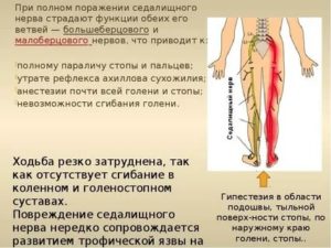 как лечить седалищный нерв