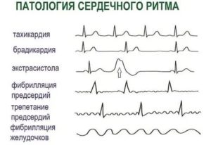 Всд тахикардия