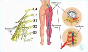седалищный нерв анатомия