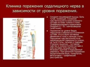 поражение седалищного нерва