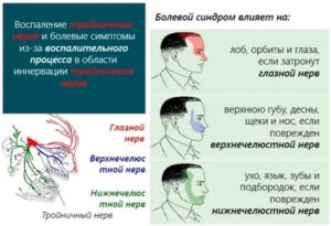 воспаление тройничного нерва